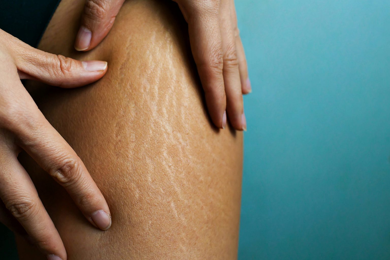 Fat Cellulite And Stretch Mark On Tan Skin Woman Leg At Home, Wo.